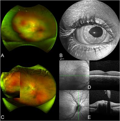 Acute Retinal Necrosis: Clinical Features, Diagnostic Pitfalls, Treatment, and Outcome of an Insidious Disease in Children. Case Report and Review of the Literature